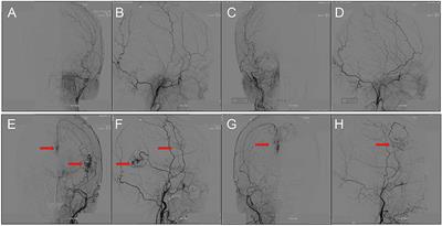 TGFβ1 as a Predictive Biomarker for Collateral Formation Within Ischemic Moyamoya Disease
